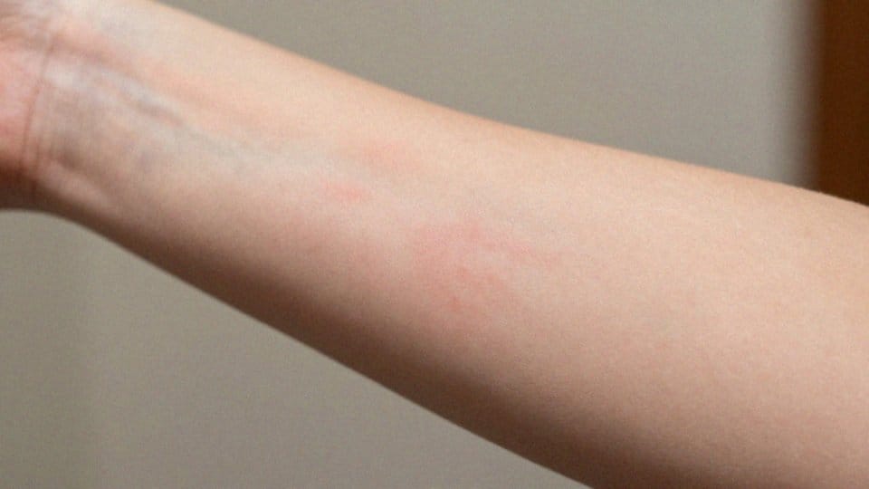 Jak rozpoznać alergię skórną po wyglądzie?